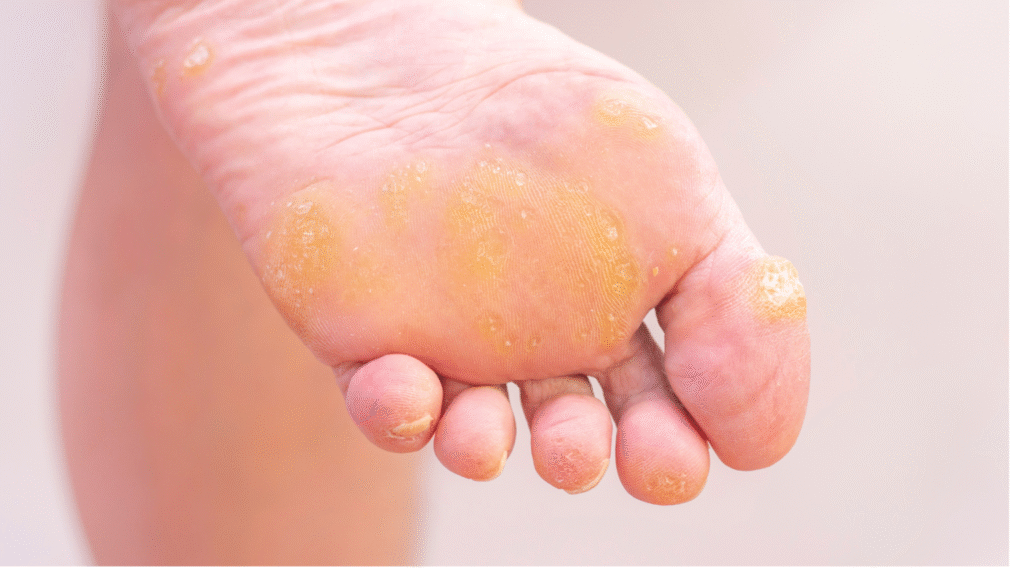 zarażenie hiperkeratozą