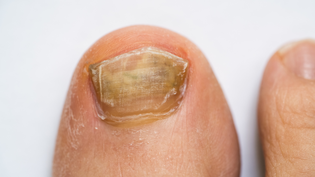 Łuszczyca paznokcia